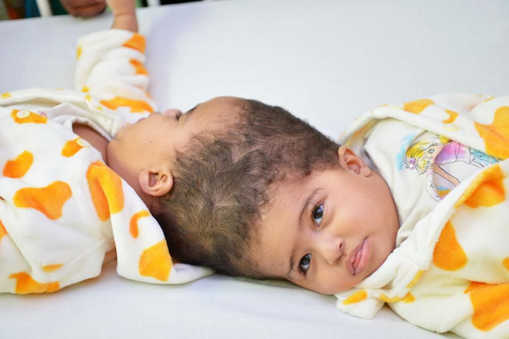 نجاح عملية فصل التوأم الملتصق الإريتري “أسماء وسمية” بعد عملية جراحية دقيقة استغرقت 15 ساعة ونصفًا