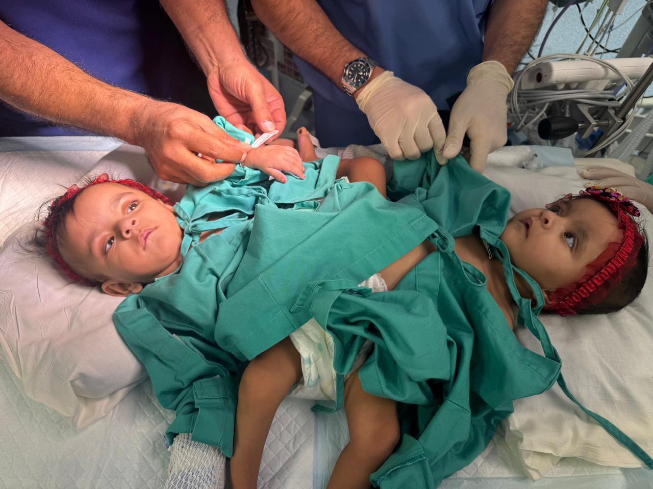 بالصور…بدء عملية فصل التوأم الملتصق السعودي “يارا ولارا”