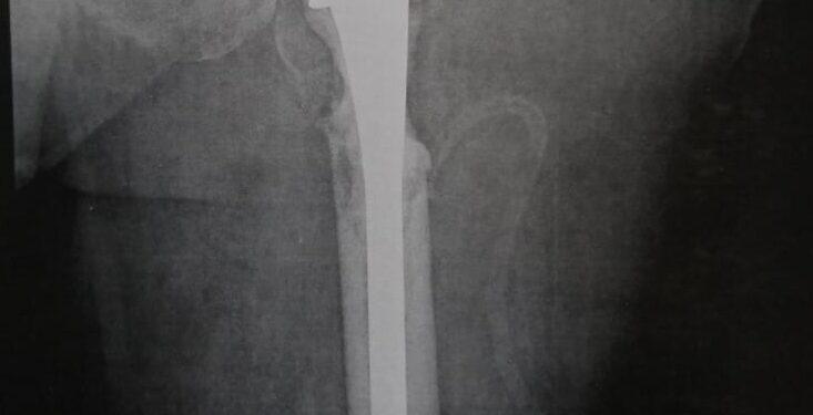 ” مستشفى ١٥ مايو ” نجاح جديد بوحدة جراحات الأورام استئصال أورام سرطانية من فخذ سيدة ستينية بعد تسببه في تأكل العظمة