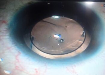 صحة الدقهلية إنقاذ عين مريضة بعد تدخل جراحي دقيق بمستشفى رمد المنصورة