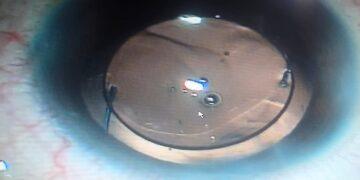 صحة الدقهلية إنقاذ عين مريضة بعد تدخل جراحي دقيق بمستشفى رمد المنصورة